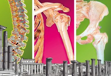 VIII CONGRESSO NAZIONALE G.I.S.O.O.S. “All Around Severe Osteoporosis”