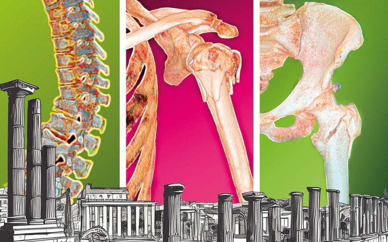 Scopri di più sull'articolo VIII CONGRESSO NAZIONALE G.I.S.O.O.S. “All Around Severe Osteoporosis”